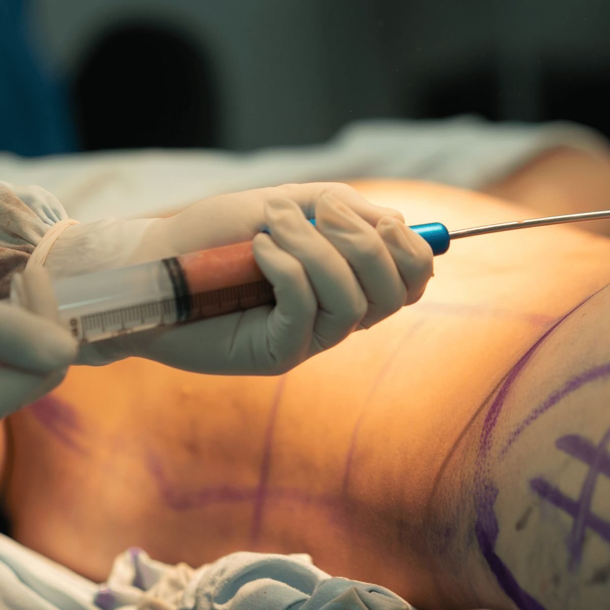 Body contouring consultation at Syinger Aesthetics