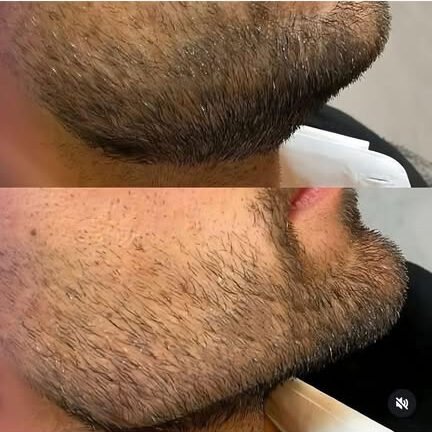 Treatment result at Syinger Aesthetics