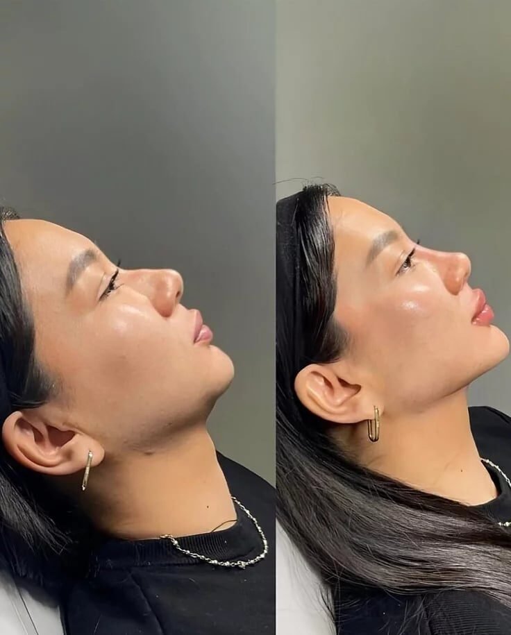 Profile treatment result at Syinger Aesthetics
